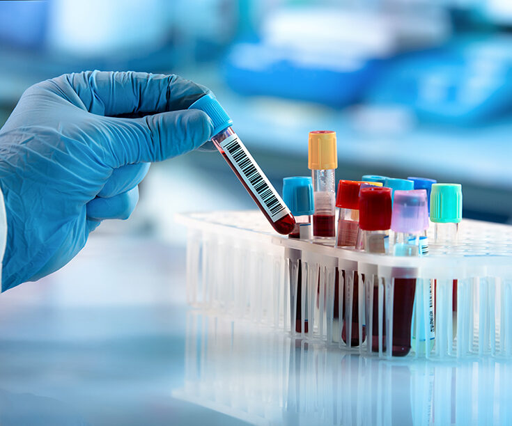 Vércseppentő a kórházi laboratóriumban, vérminták vizsgálata.